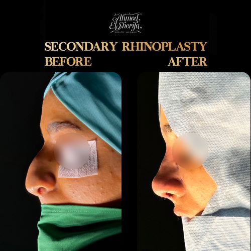 شكل الوجه بعد عملية تجميل الأنف